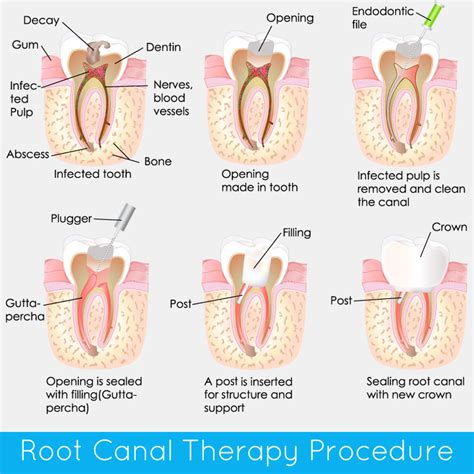 Root Canal Therapy Procedure - Belmont Dental Care