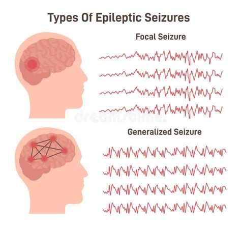 Types of Epilepsy. Generalized and Focal Seizures Stock Vector - Illustration of medicine ...