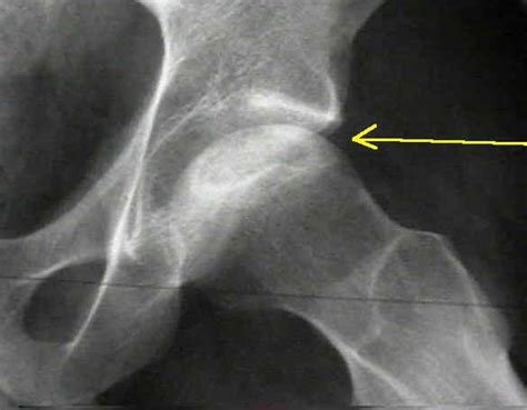 ORTHOPAEDICS: Avascular Necrosis of Bone