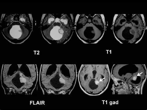 Figure 30 from Pilocytic Astrocytoma. Typical and Atypical CT and MRI ...