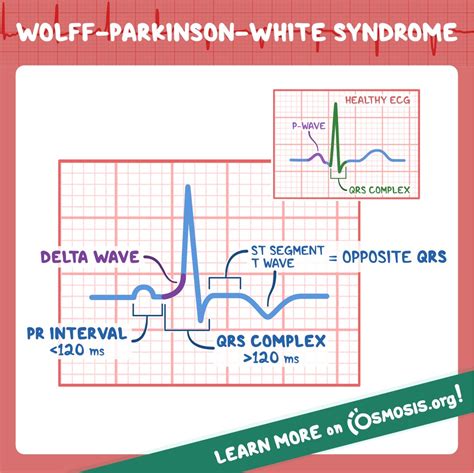 Wolff Parkinson White Syndrome