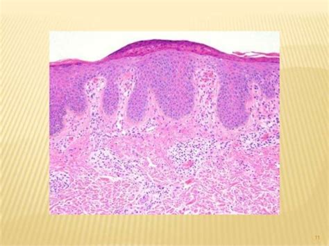 Chronic actinic dermatitis