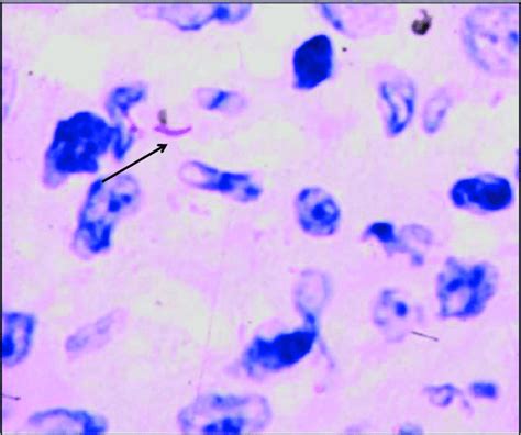 Ziehl Neelsen Acid Fast Staining Of Granuloma Shows Presence Of | My ...