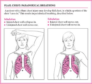 Blunt-Force Trauma : Interventions for Flail Chest