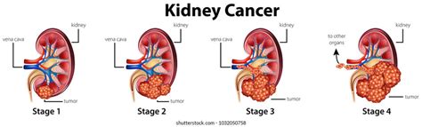 Kidney Stages Photos, Images and Pictures