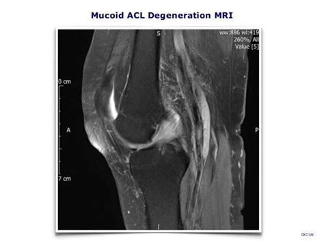 Mucoid ACL Degeneration