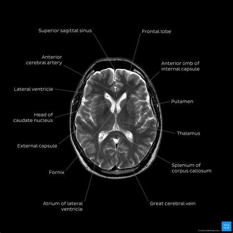 How To Read A Mri Of Brain Brain Anatomy Mri Explained In English | The Best Porn Website