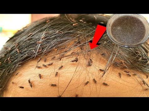 How to Remove "lice eggs" and "lice in hair" permanently - YouTube | Lice eggs, Lice removal ...