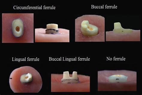 Effect of ferrule location on the fracture resistance of crowned ...