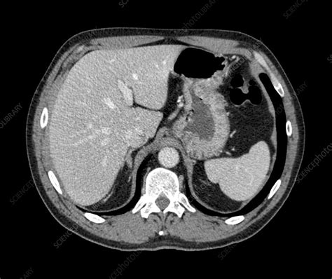 Normal liver and spleen, CT scan - Stock Image - C014/7032 - Science ...