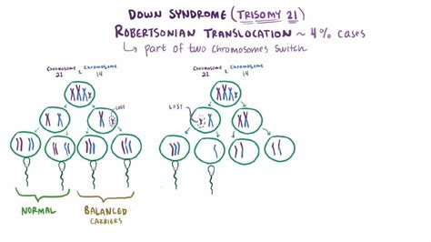 Down Syndrome (Trisomy 21) - Pediatrics - Merck Manuals Professional Edition