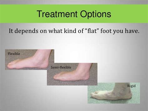 Flat Feet Treatment Options