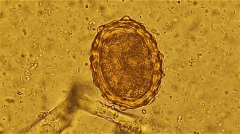 Ascaris lumbricoides in stool microscopy.Round Worm under microscope. - YouTube