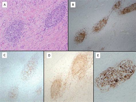 A: Histological features of isolated germinal centers noted in ...