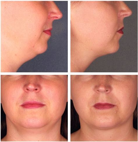 Kybella Injections | Double Chins | Photo | Las Vegas Nevada | Before After