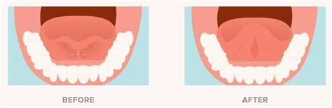 Mucocele & Tongue Tie Frenectomy - Dr. Changule 's Face Clinic And Research Center