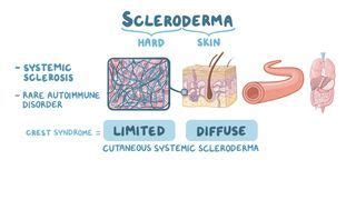 Induration: What Is It, Causes, and More | Osmosis