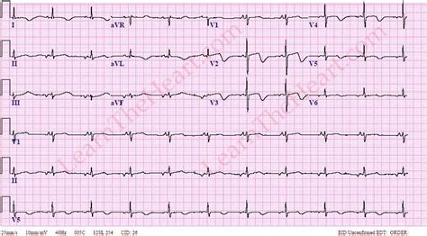 Ectopic Atrial Bradycardia (Example) | Learn the Heart