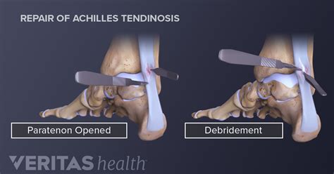 Injections and Surgery to Treat Achilles Pain