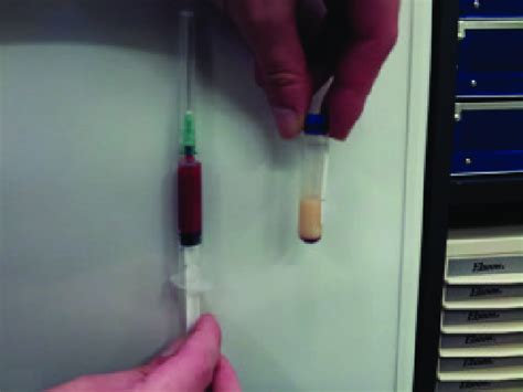 Chylous effusion contaminated with peripheral blood. Note the milky... | Download Scientific Diagram