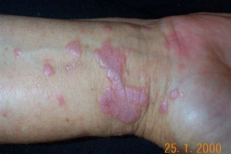 Chronic Plaque Psoriasis: Home Remedies, OTC, Prescriptions