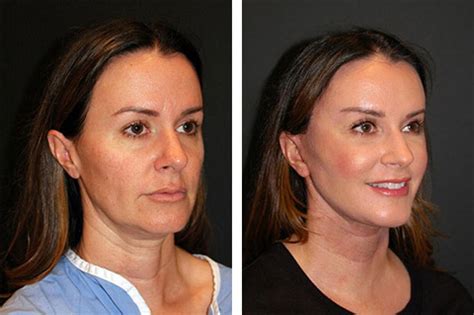 Facelift Surgery: 5 Useful and Significant facts