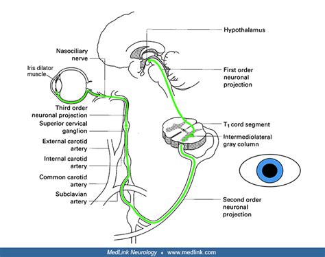 Horner syndrome | MedLink Neurology