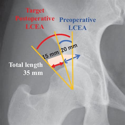 Preoperative planning. LCEA, lateral center-edge angle. | Download Scientific Diagram