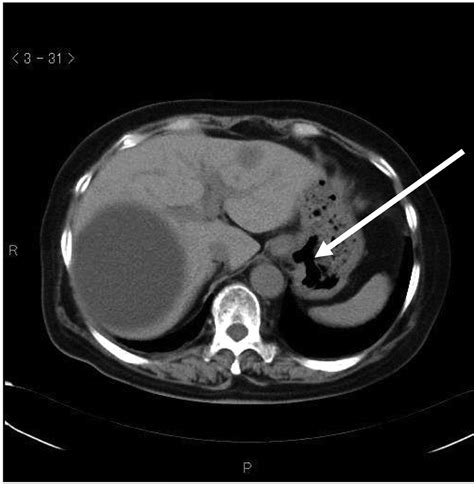 Gastric Tumor from Metastasis of Breast Cancer