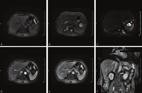 MRI of patient's pancreas MRI. (A) Routine pancreatic MRI scan showed a... | Download Scientific ...