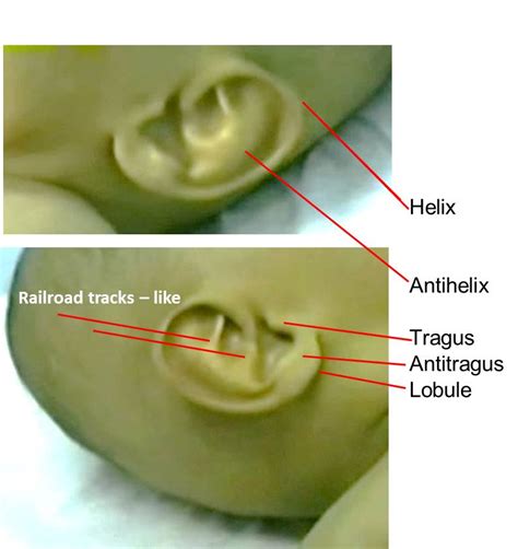 Railroad Tracks-Like Ears – Clinical Eye Openers