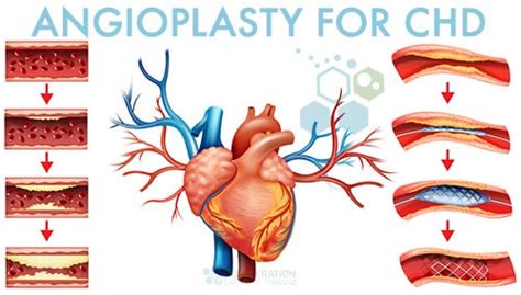 Stem Cell Therapy for Heart Disease Atherosclerosis CAD IHD