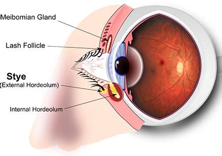 Eye Stye Removal & Treatment · Top Eye Doctor, Ophthalmologist · NYC