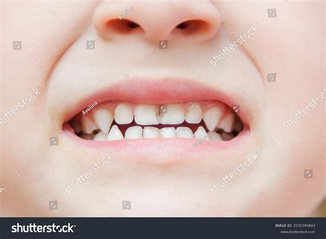 349 White Spots Child Teeth Images, Stock Photos & Vectors | Shutterstock