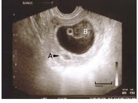 Early pregnancy with regression of intrauterine implantation site (a ...