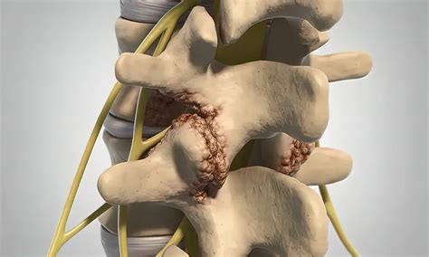 Medial Branch Blocks for Knoxville, TN | Pain Medicine of the South | Interventional Pain Medicine