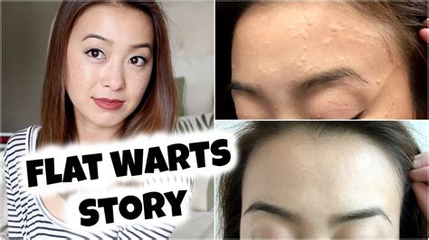 My Flat Warts Story + Spontaneous Regression (With Pictures) - YouTube