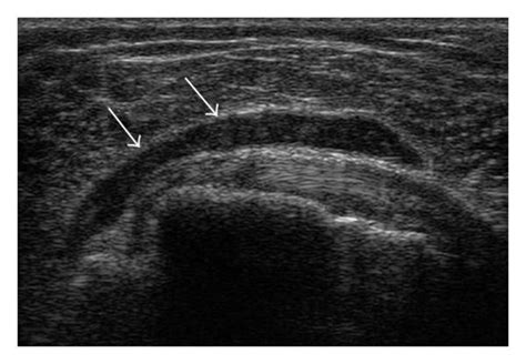 Subdeltoid Bursitis Shoulder