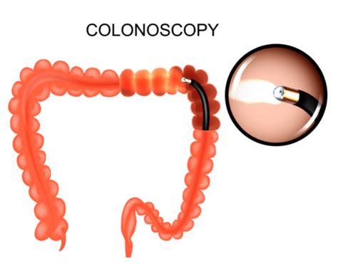 Why a Colonoscopy Is Important: Colorectal Cancer Screening-Gidoc CPT