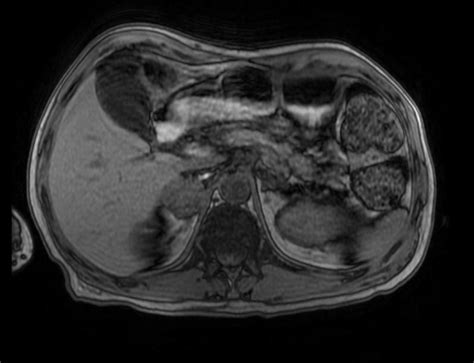 Pheochromocytoma MRI - wikidoc