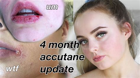 4 MONTH ACCUTANE UPDATE | HORRIBLE SIDE EFFECTS?!? | Conagh Kathleen - YouTube