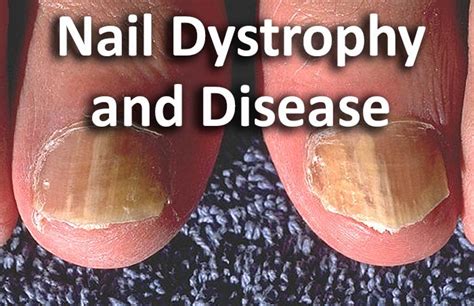 Nail Dystrophy and Disease | Contour Dermatology