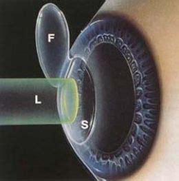 Laser Eye Surgery Risks | How To Improve Vision Naturally