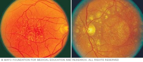 Dry macular degeneration - Diagnosis and treatment - Mayo Clinic