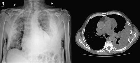 Hemothorax - Thoracic Surgery Clinics