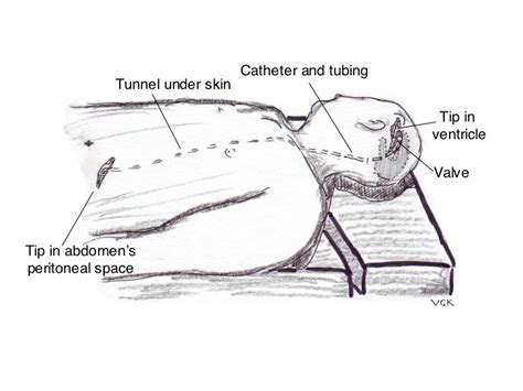 Ventricular Peritoneal Shunt Placement