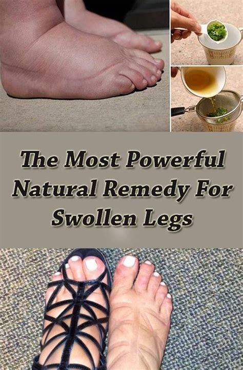 Powerful Natural Remedy For Swollen Legs ! - TOP 5 DIY