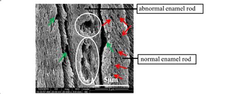 SEM image of normal and abnormal enamel rods in the outer layer of the... | Download Scientific ...