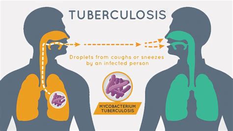 Tuberculosis Risk Factors, Causes, and Prevention | EverydayHealth