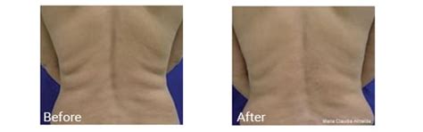 Accent Body Contouring | Hollywood Dermatology